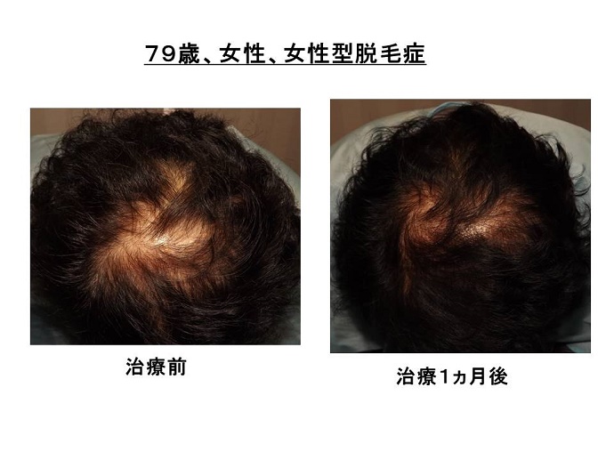 円形脱毛症　病院""